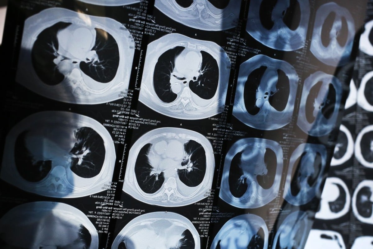 Yitu’s new tool highlights an AI application area in which China is strong – in part because of the country’s AI drive but also because the country is home to one in every five cancer patients globally, according to government statistics. Photo: SCMP